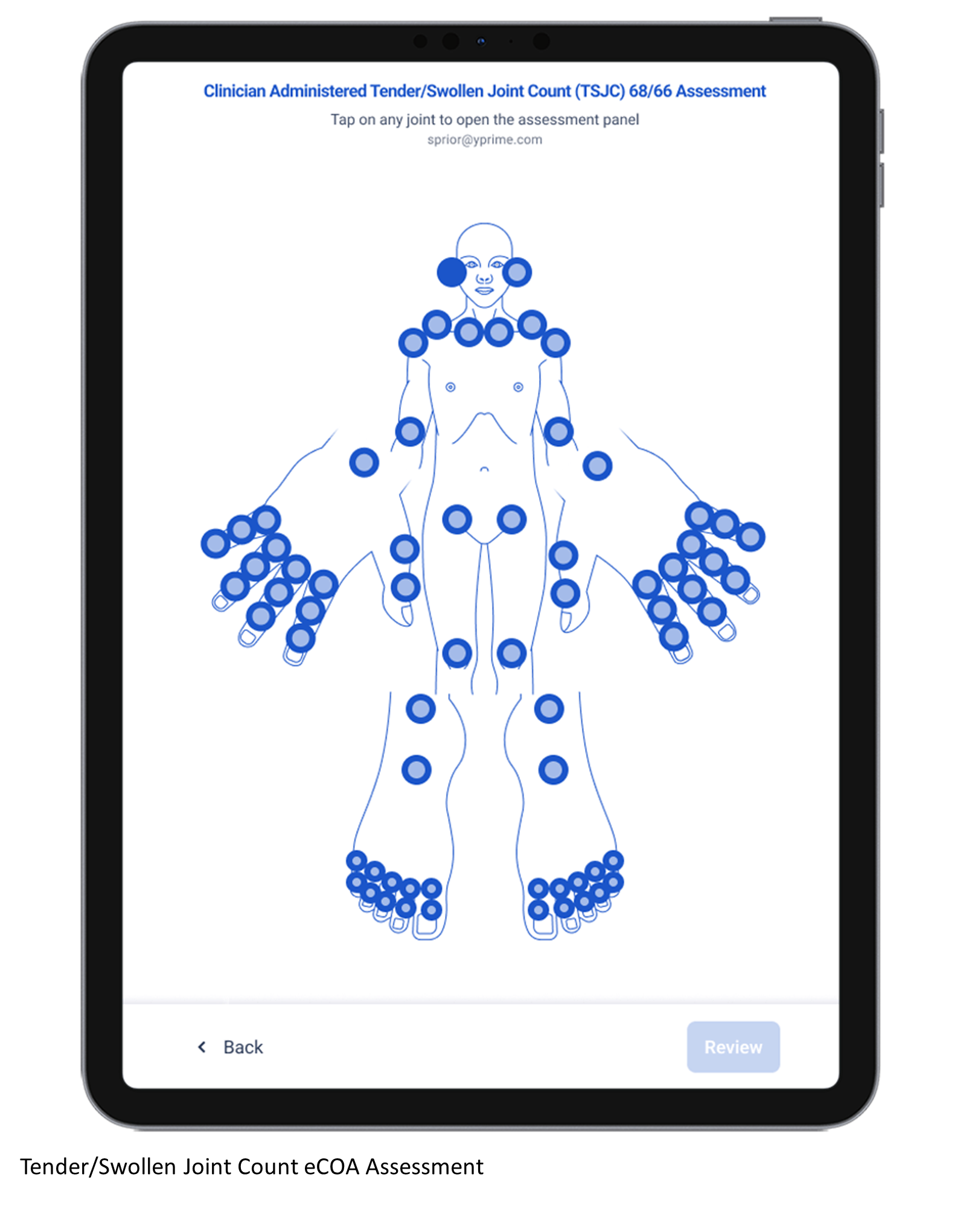 tender swollen joint count assessment